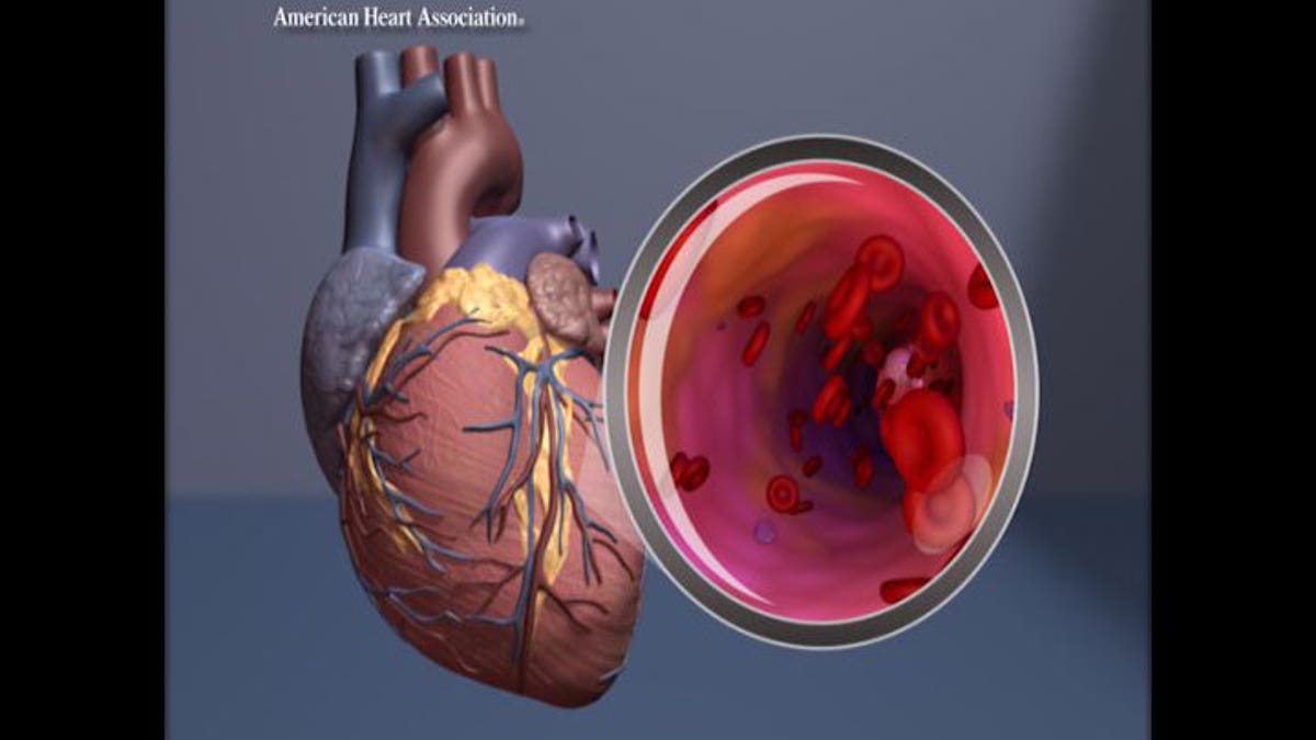 Heart with view of the artery