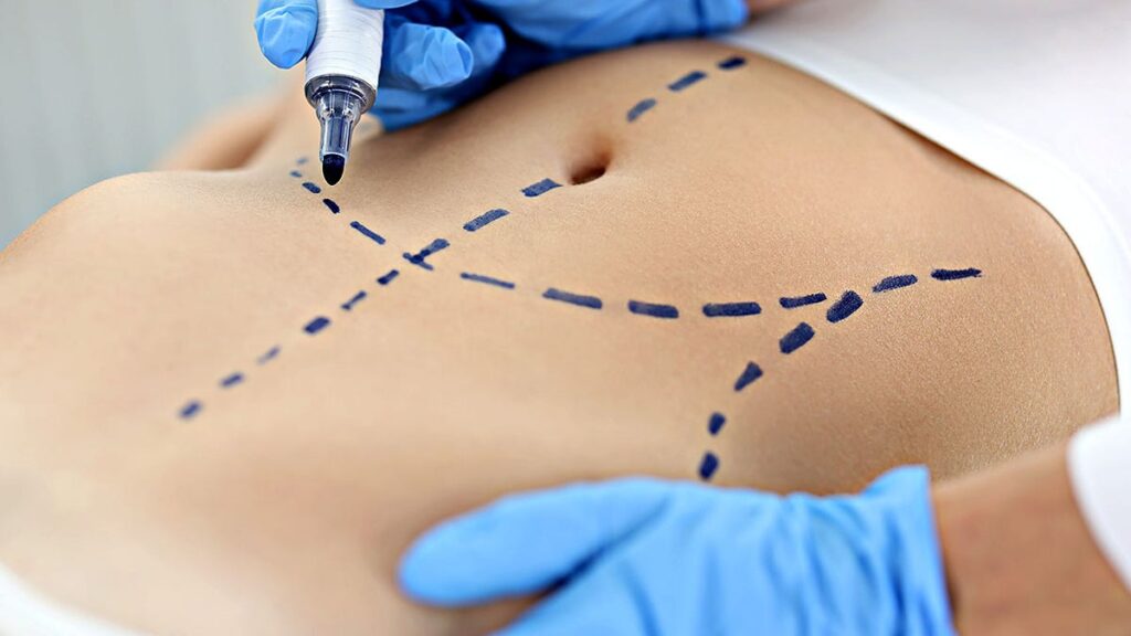 Only a surgical procedure is more popular than breast increase: see report