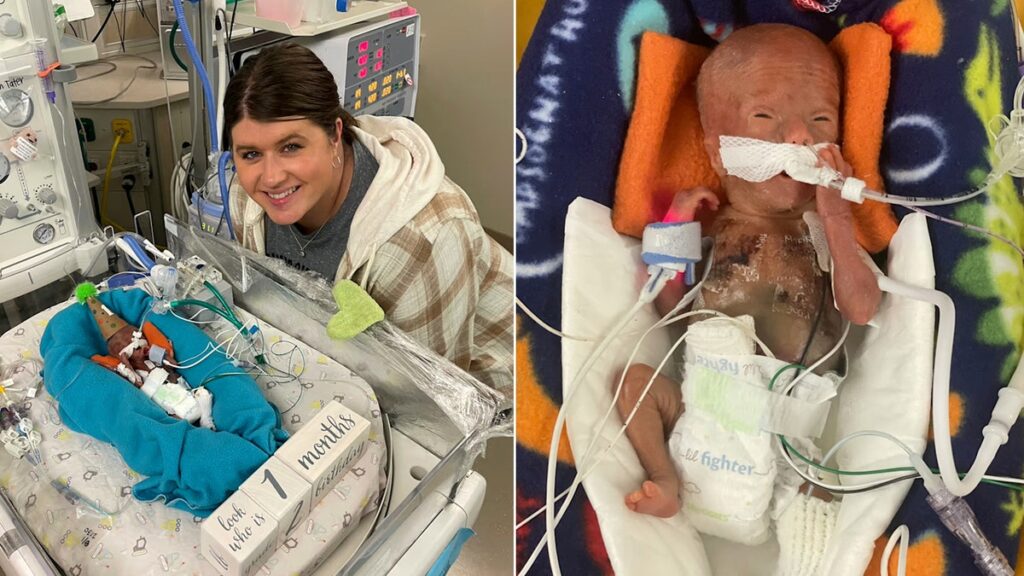 The world's most premature baby challenges all the odds to reach the first birthday